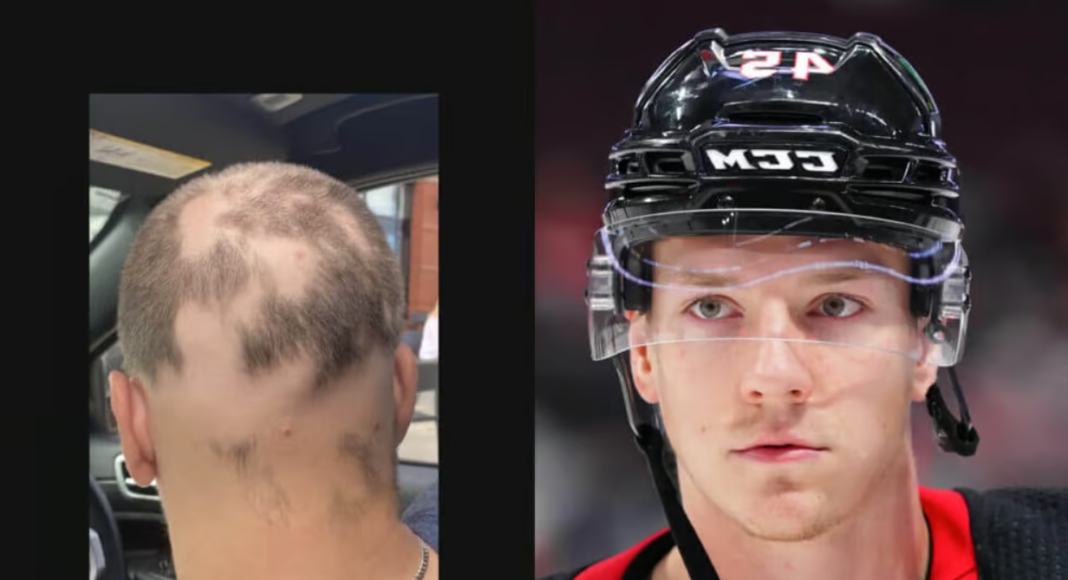 Wstydliwy problem hokeisty NHL. Jego organizm zwalcza… włosy